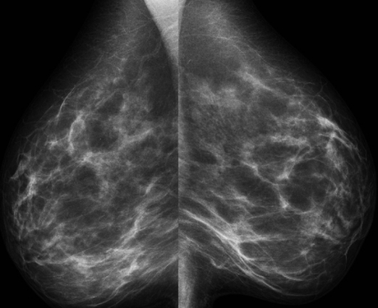 Маммография молочных желез 4. Маммография снимки норма. Маммография снимок в норме. Маммография здоровых молочных желез. Маммография здоровых молочных желез снимок.