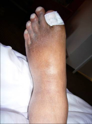 Кракът на д-р Масаро Емото преди терапията с МаРиТе